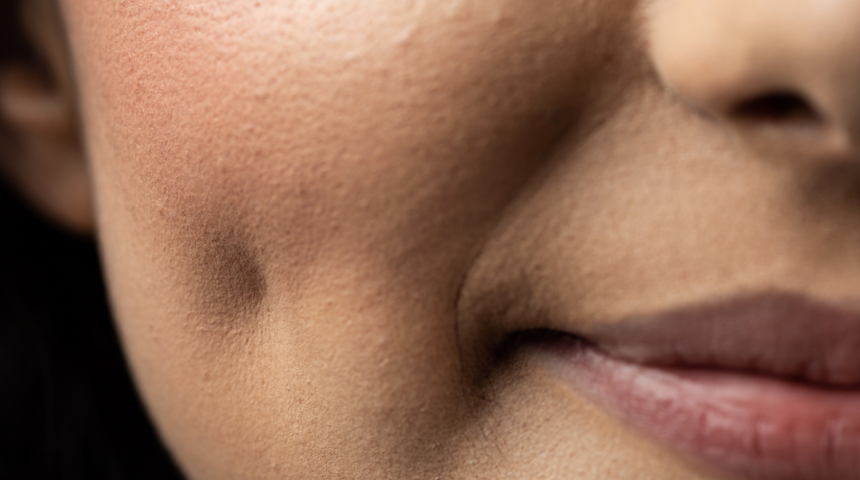 Ameliyat masasına bile yatıyorlar! İşte yanak gamzesi için 4 etkili yol