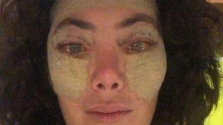 Akasya Asıltürkmen göz kapağını kaldırttı! Estetik sonrası halini paylaştı