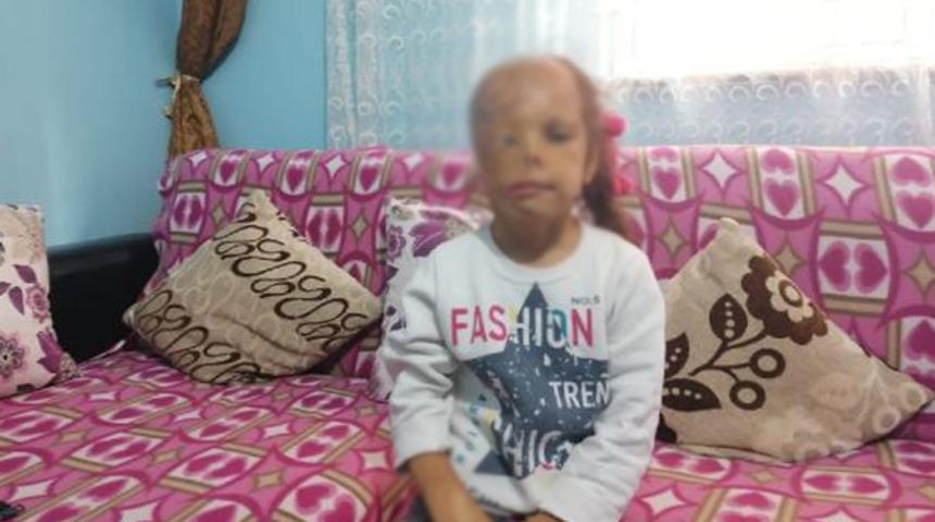 Bebekken yüzü yanan Dilara'nın annesinden yardım çağrısı