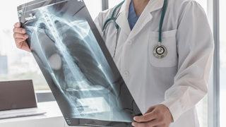 Tüberküloz nedir? Tüberküloz nasıl bulaşır?