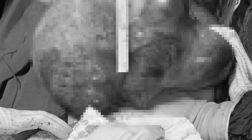 'Karnım ağrıyor' diyerek gittiği hastanede karnından 7 kiloluk kitle çıktı