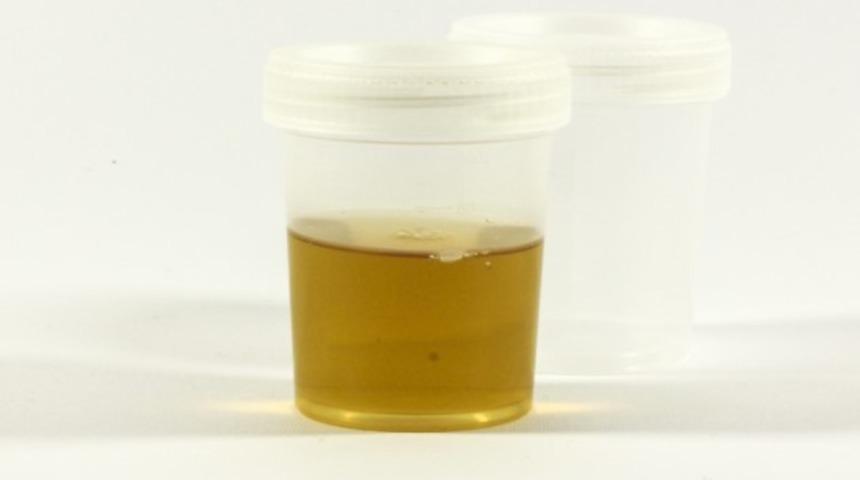 İdrarda epitel nedir? İdrarda epitel değeri kaç olmalıdır? Düşüklüğü ile yüksekliği nedenleri ve belirtileri