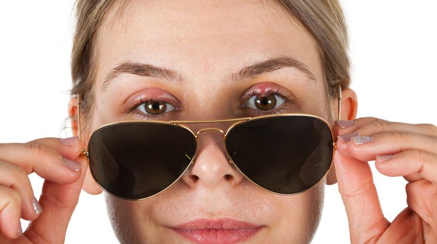 Arpacık nedir? Nedenleri, belirtileri, tedavisi