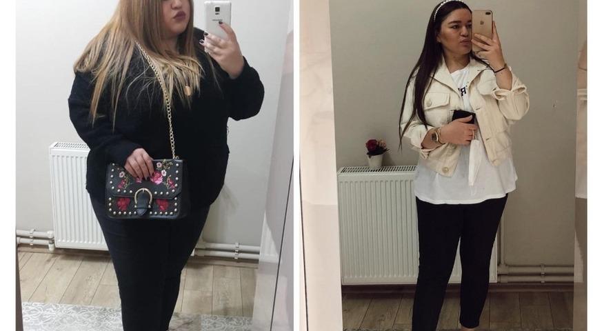 Mide k&uuml;&ccedil;&uuml;ltme ameliyatı ile 9 ayda 58 kilo verdi