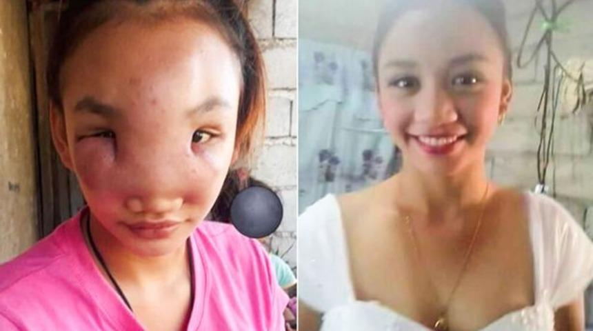 Sivilce sandığı şişliği sıkınca tanınmaz hale geldi! K&ouml;r ve sağır kalabilir 