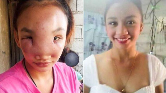 Sivilce sandığı şişliği sıkınca tanınmaz hale geldi! Kör ve sağır kalabilir 