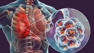 Zatürre spor yapan kişileri de etkiliyor! Korunmak için ne yapmalıyız? 