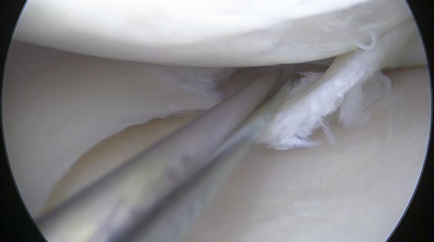 Menisküs yırtığı tedavisinde tek çare ameliyat mı? 