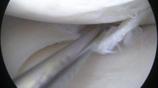 Menisküs yırtığı tedavisinde tek çare ameliyat mı? 