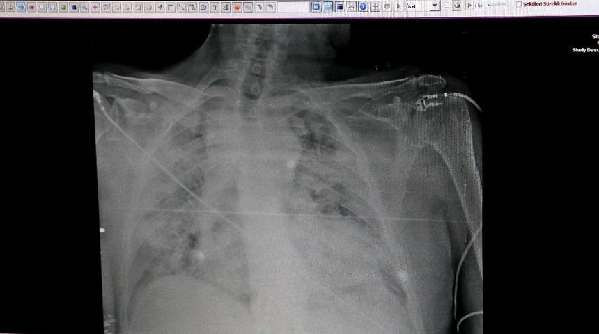 Korkutan görüntü! İşte koronalı hastaların akciğer röntgeni