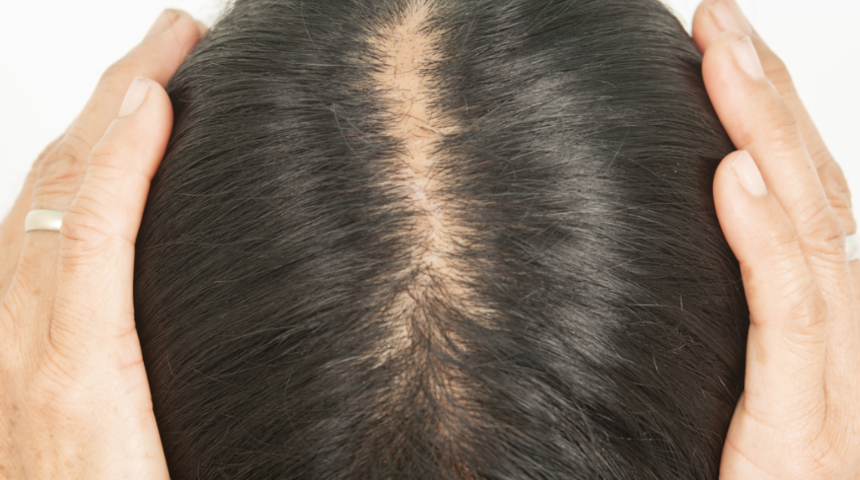 Saçınızın dökülmesine neden olan alışkanlıklar! Bu bile zarar veriyormuş