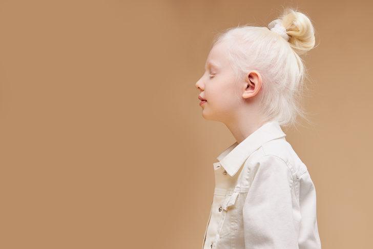 Albino Hastaligi Nedir Tedavisi Var Mi Saglik Haberleri