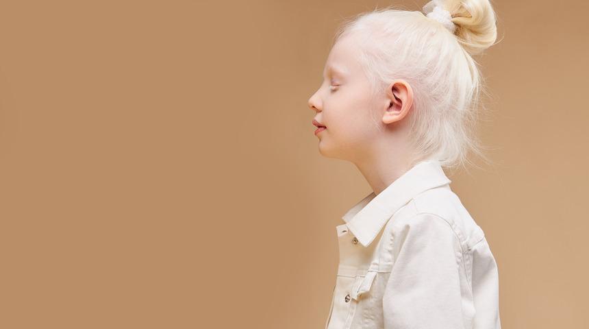 Albino hastalığı nedir? Tedavisi var mı?