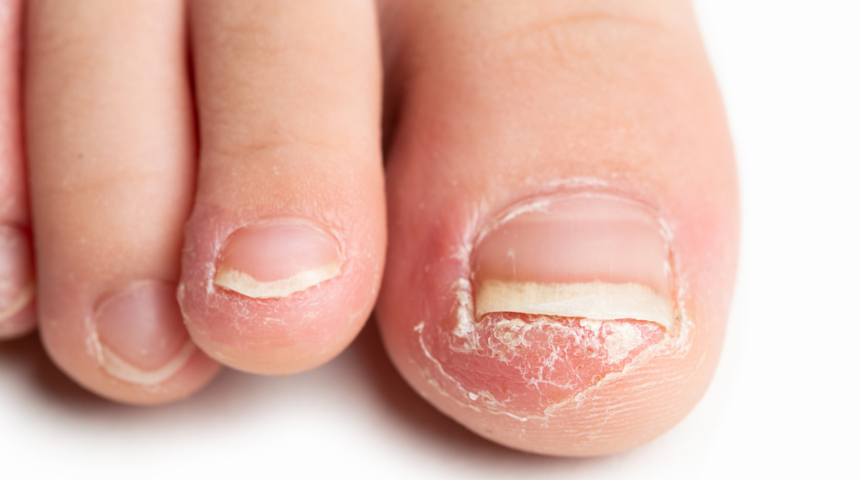Batık tırnakla bu yöntemlerle mücadele edin! Günde en az 2 kez, 15 dakika boyunca...