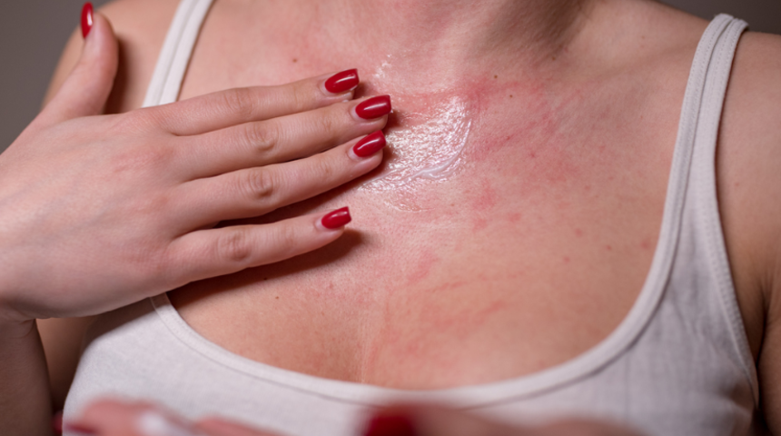 Ev yapımı egzama kremi tarifi! Yanmayı ve ağrıyı ortadan kaldırıyor