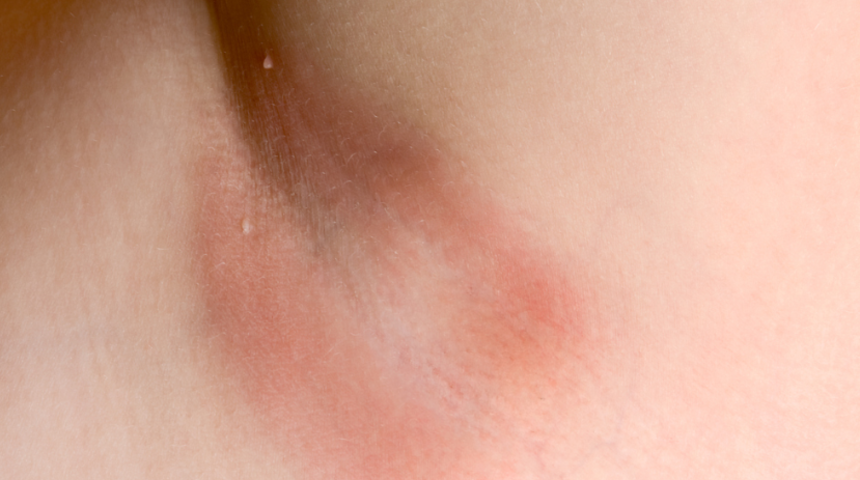 Kaşıntılı koltuk altına ev çaresi! Lavanta, hindistan cevizi yağı...