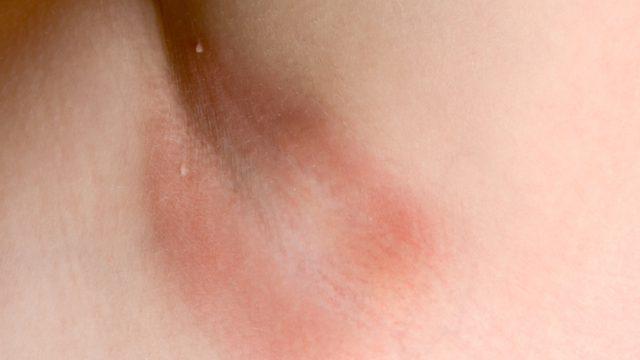 Kaşıntılı koltuk altına ev çaresi! Lavanta, hindistan cevizi yağı...