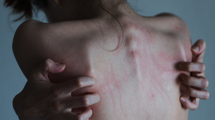 Sirke ve çay ağacı tarifiyle sırtınızdaki sivilceler anında yok oluyor