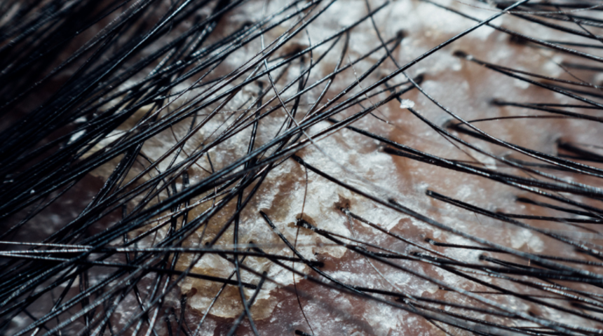 Lapa lapa dökülen kepeğe son! Kimyasal kullanmadan sirke ve limon suyu ile...