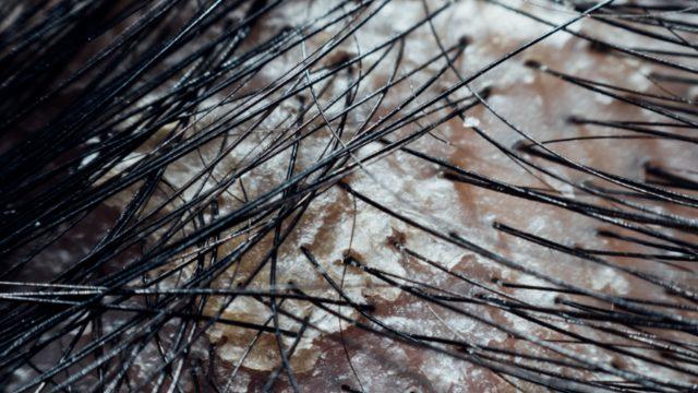 Lapa lapa dökülen kepeğe son! Kimyasal kullanmadan sirke ve limon suyu ile...