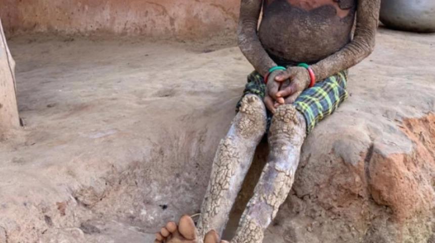 Nadir görülen hastalığı 9 yaşındaki kızı taşa çeviriyor