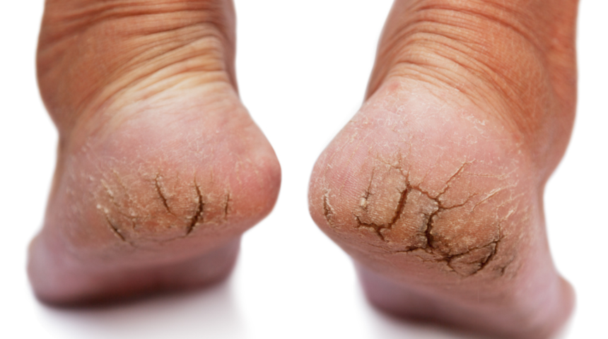 Zımpara kağıdı gibi ayaklara son! Topuk çatlağına ne iyi gelir? İşte cevabı