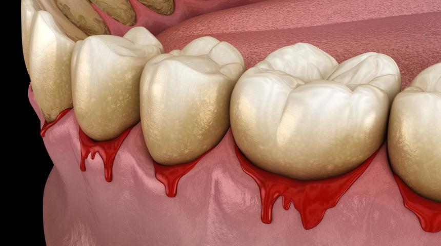 Yaygın bir rahatsızlık olan gingivit nedir? Gingivit neden olur?