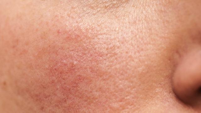 Lupus hastalığı nedir? Lupus hastalığı tedavisi nasıldır?