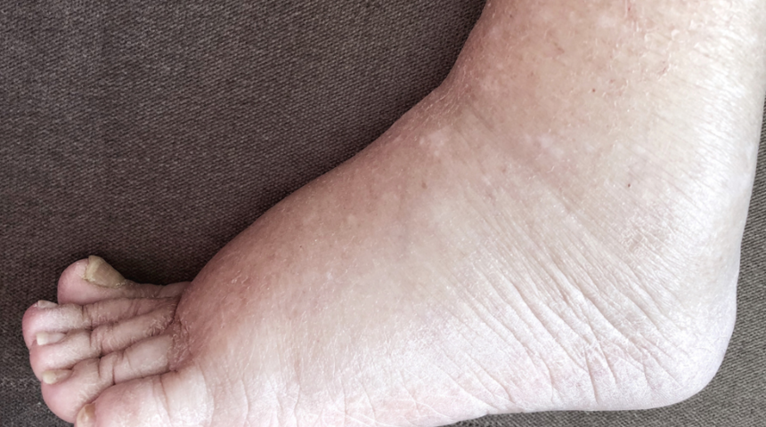 Şişmiş el ve ayaklara veda edin! &Ouml;dem nasıl atılır? İşte cevabı