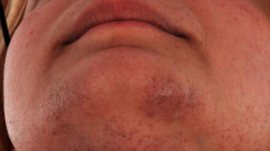 Gizli sorun! Kadınların &ccedil;ene altında kıl neden &ccedil;ıkıyor? İşte 5 &ouml;nemli nedeni