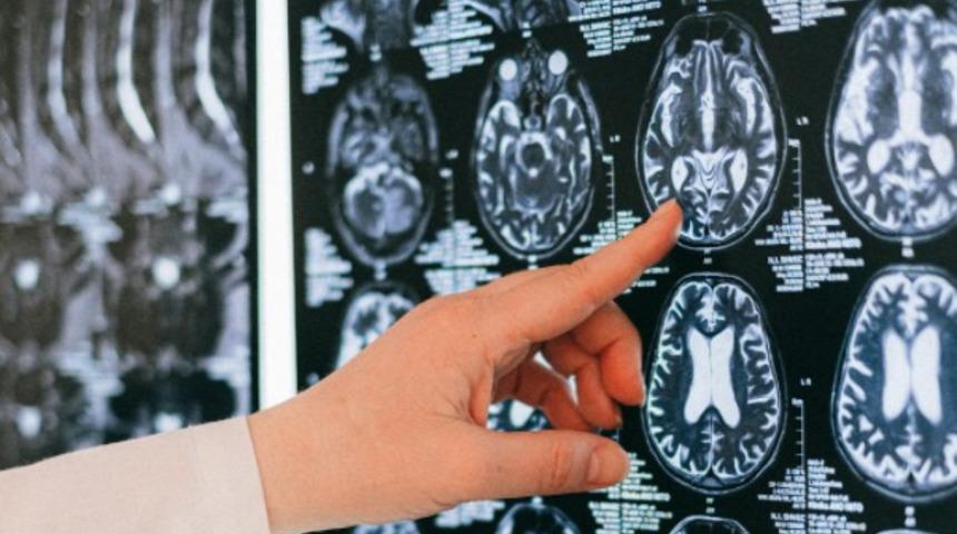 Beyincik dejenerasyonu nasıl ortaya çıkar? Belirtileri nedir?