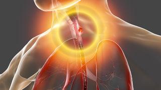 Gırtlak kanseri belirtileri nelerdir? Gırtlak kanseri nasıl tedavi edilir?