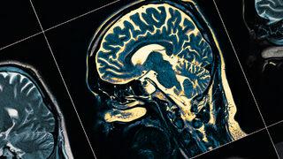 Beyin ölümü nedir? Beyin ölümü nasıl gerçekleşir?