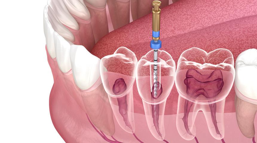 Diş sağlığı açısından önemlidir: Kanal tedavisi nasıl yapılır?