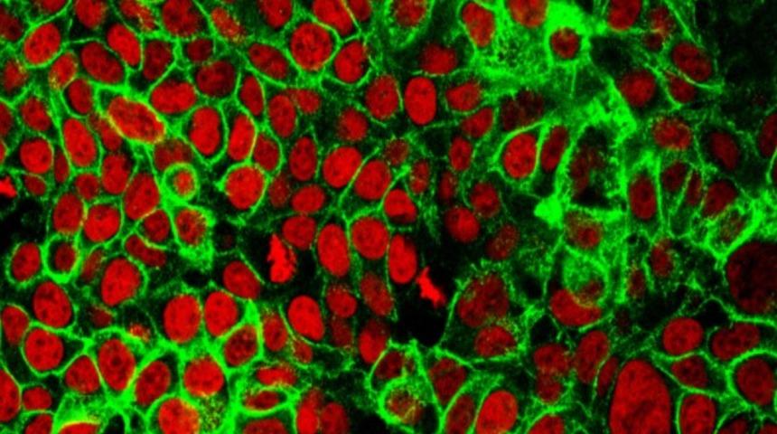 Hemolitik anemi tedavisi nasıl yapılır? Belirtileri nelerdir?