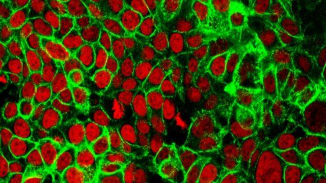 Hemolitik anemi tedavisi nasıl yapılır? Belirtileri nelerdir?