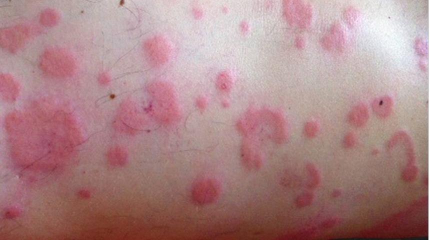 Histamin nedir? Histamin etkileri nelerdir? Histamin intoleransı belirtileri nelerdir?