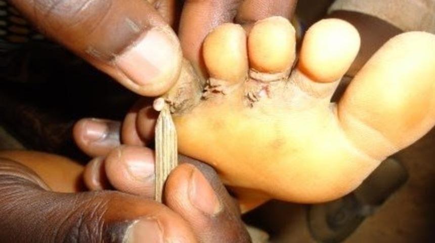 Tırnak mantarına ne iyi gelir? Evde tırnak mantarı nasıl geçer, doğal tedavi yöntemleri neler?