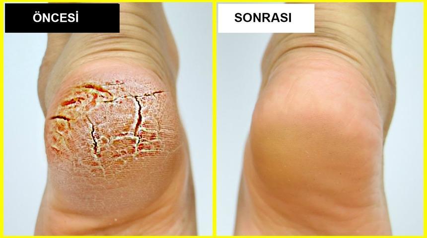 Babaanne y&ouml;ntemiyle topuk &ccedil;atlaklarınıza veda edin