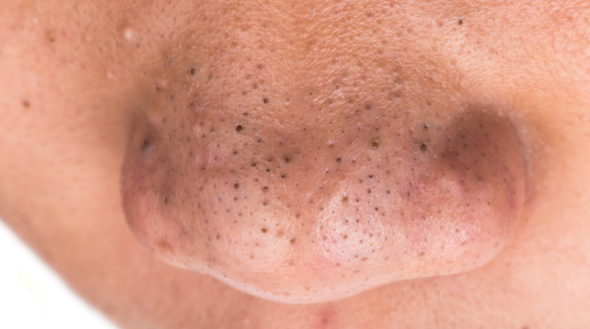 Dermatologlar açıkladı! Siyah nokta temizleme bandı kullanıyorsanız eğer...