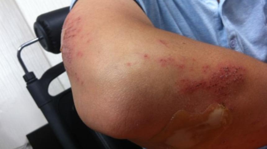 Kontüzyon nedir? Kontüzyon travmalarında ne gibi sorunlar yaşanır?