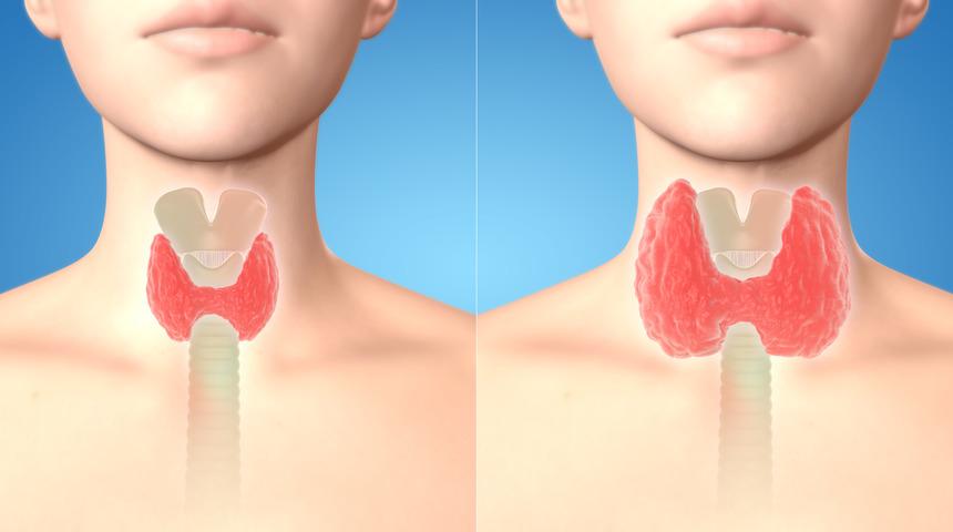 Tek çare iyot değil: Guatrın belirtileri nelerdir?