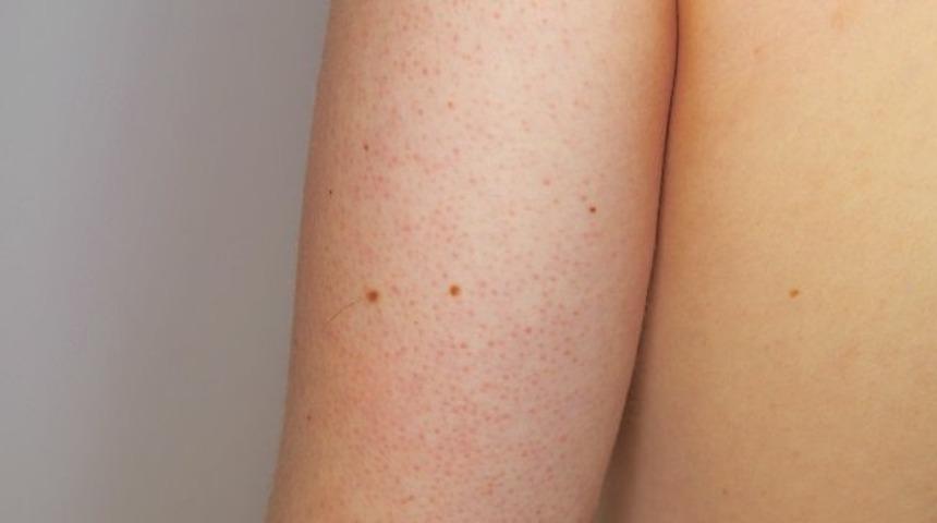 Tavuk derisi hastalığı nedir ve nasıl tedavi edilir?