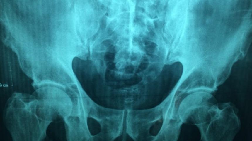 Uyluk kemiği ağrısına ne iyi gelir? Uyluk kemiği nedir, nerede bulunur?