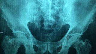 Uyluk kemiği ağrısına ne iyi gelir? Uyluk kemiği nedir, nerede bulunur?