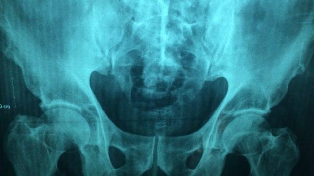 Uyluk kemiği ağrısına ne iyi gelir? Uyluk kemiği nedir, nerede bulunur?