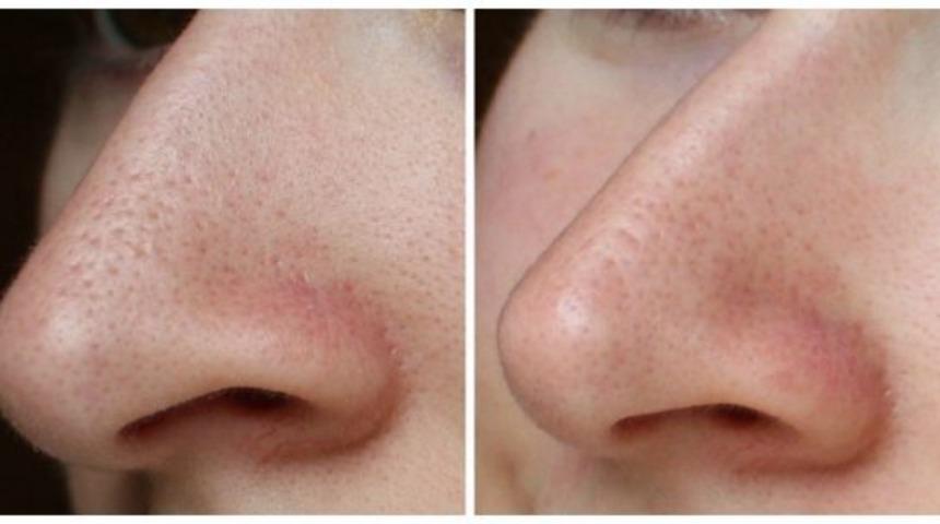 Tertemiz bir cilt isteyenlere: Siyah noktaları k&ouml;k&uuml;nden s&ouml;ken 5 etkili y&ouml;ntem