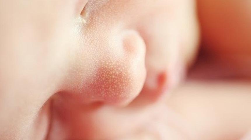 PKU (fenilketon&uuml;ri) hastalığı nedir? PKU nedenleri nelerdir?