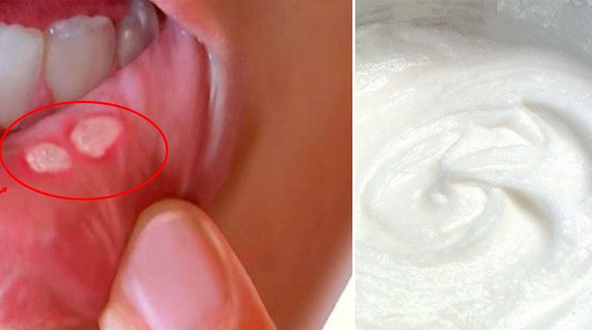 Acısıyla g&uuml;nleri zehir eden ağız &uuml;lserinden (aftlardan) kurtulmanızı sağlayacak 10 tarif