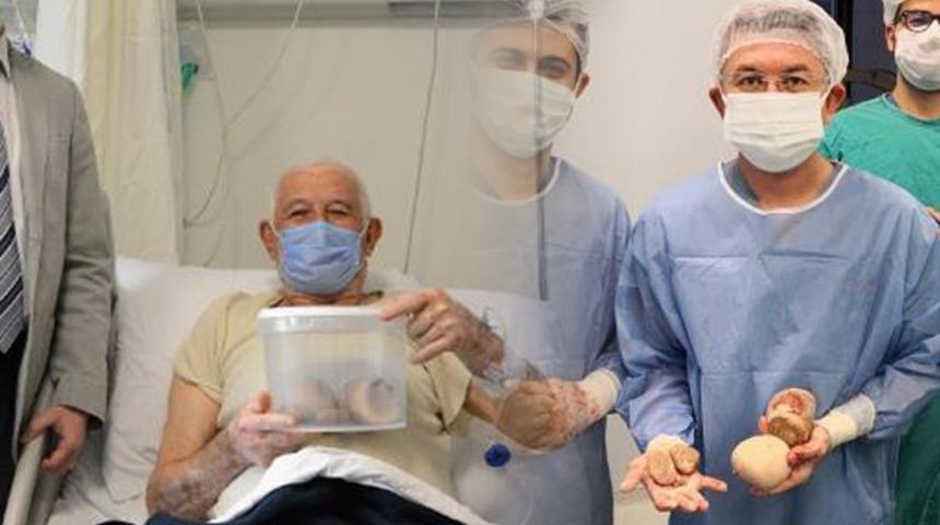 Mesanesinden çıkarılan taşların boyutu doktorları bile şaşırttı